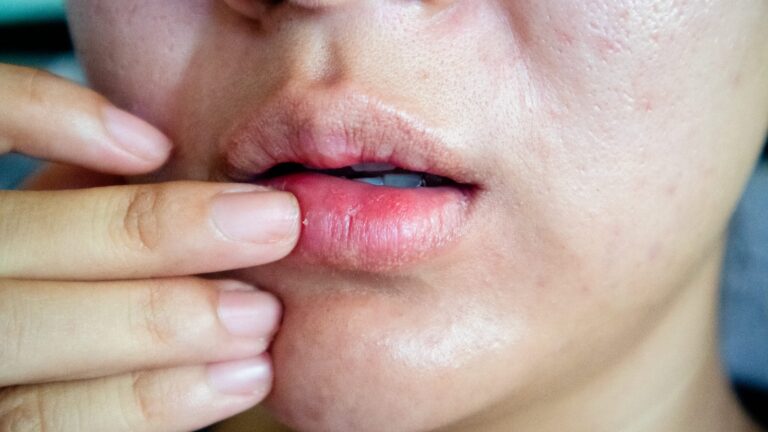 Câncer de boca, Maio Vermelho, saúde bucal, oncologia, HPV, prevenção